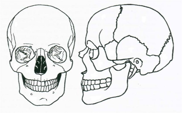 Implantación de un cráneo hecho con impresora 3D – Grupo de Nuevas  Tecnologías de la SoMaMFyC
